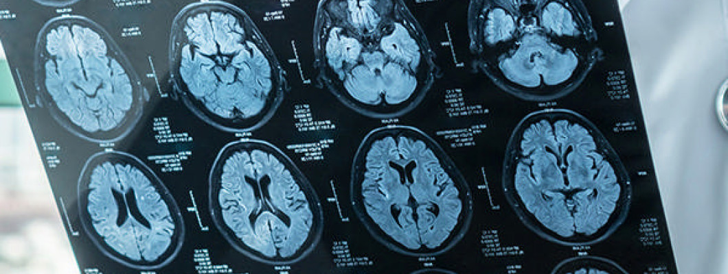Gamma Knife