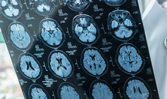 Gamma Knife