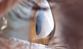 Cornea Transplant